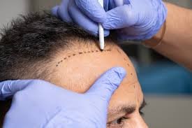 Is a Hair Transplant Suitable for Advanced Baldness?